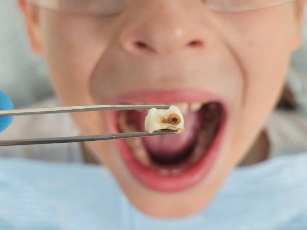 Best Same-Day Emergency Dental Services in Fisher, IL